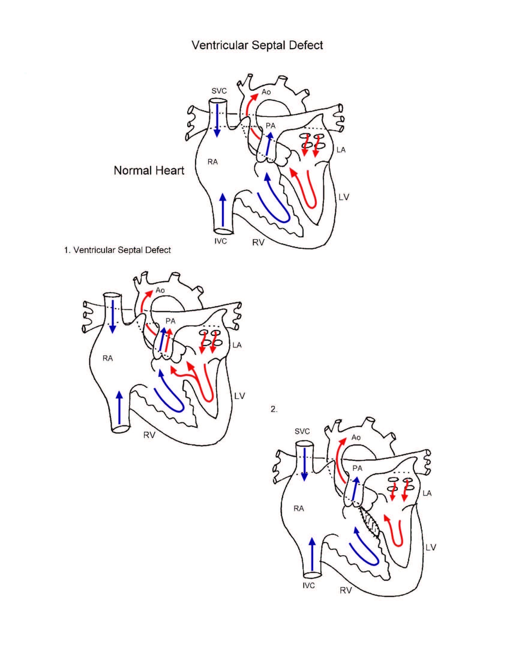 Ventricular Septal Defect illustration
