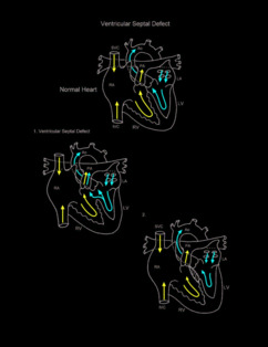 Ventricular Septal Defect illustration