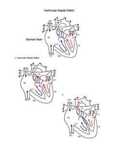 Ventricular Septal Defect illustration