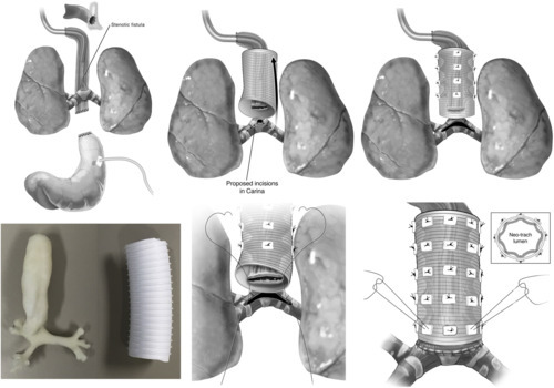 Process of placing tracheal tube