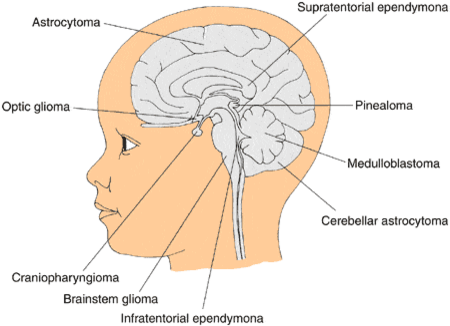 Diagram of the different types of brain tumors