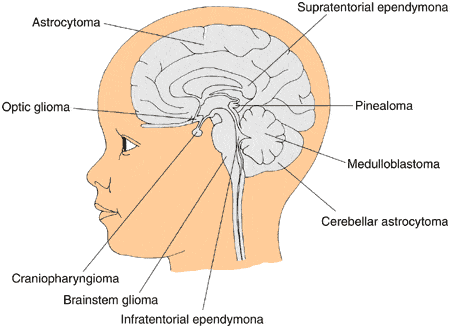 brain tumors