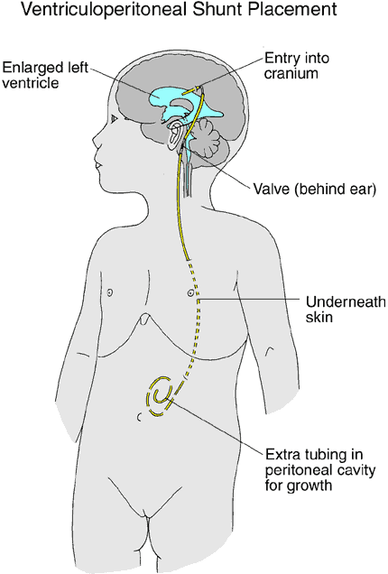 Ventriculoperitoneal shunt placement in child