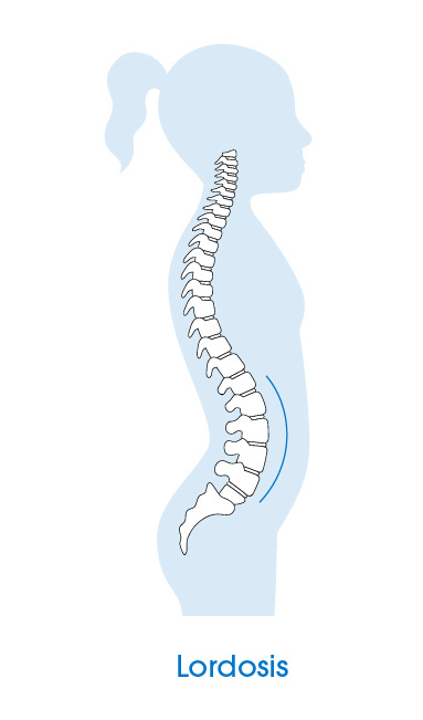 Lordosis Spine