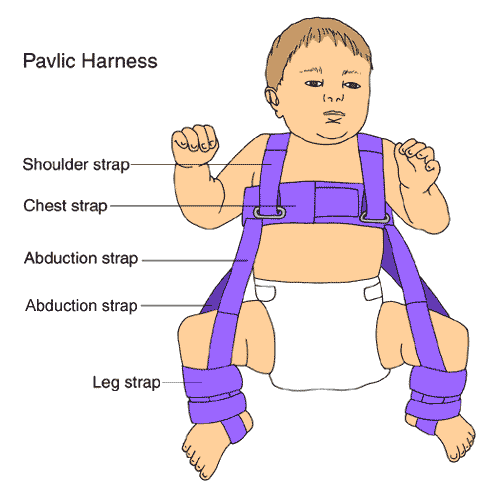 Short leg hip spica cast diagram for Hip Dysplasia