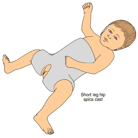 Short leg hip spica cast diagram for Hip Dysplasia