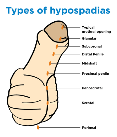 Types of Hypospadias drawing