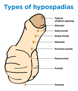 Types of Hypospadias drawing