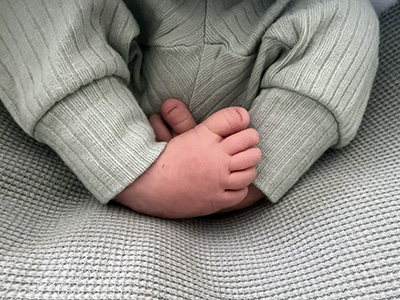 Clubfoot Children's Wisconsin Orthopedics Program