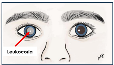 leukocoria