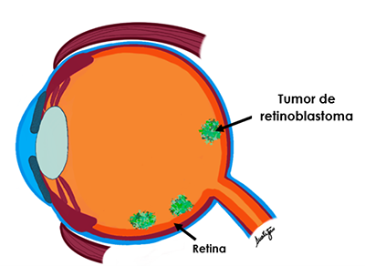 Retinoblastoma