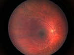 Digital retinal photographs