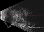 Ultrasound