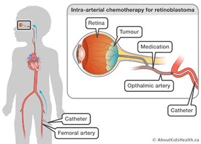 quimioterapia intraarterial