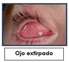 ojo extripado