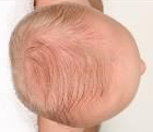 flattened back of a child's head