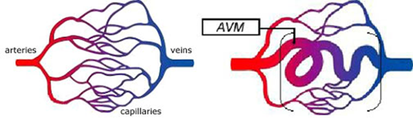 How Long Does Avm Surgery Take