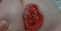 Janes birthmarked butt cheek