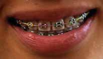 orthodontics_braces