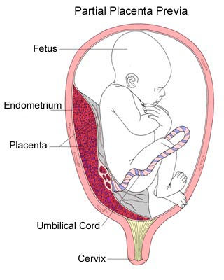 Causes of bleeding in pregnancy, Placenta previa & placental abruption