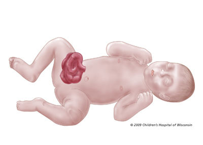 Gastroschisis  Children's Wisconsin