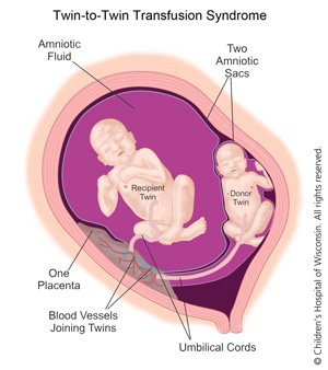 Twin pregnancy identical Risks of