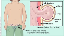 What causes abdominal hernias in paeds and adults?