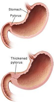 Pyloric stenosis