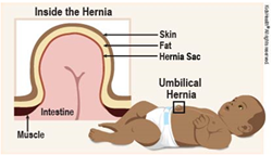 Quick Facts: Umbilical Hernia in Children - Merck Manuals Consumer