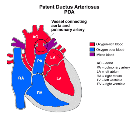 Patent Ductus Arteriosus Pda