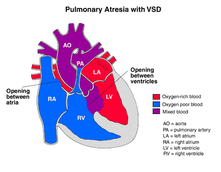 Pulmonary Atresia