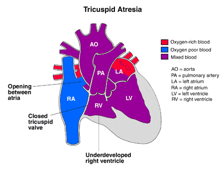 Tricuspid Atresia | Congenital Heart Defect (CHD) | Children's Wisconsin