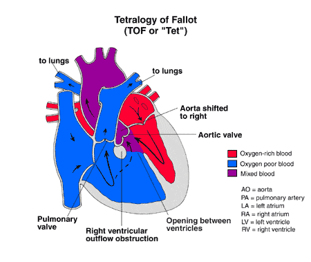 Tetralogy Of Fallot Defects