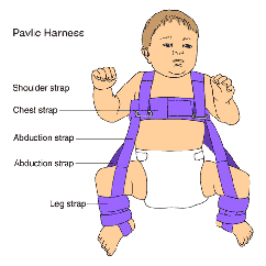 Treatments for hip sales dysplasia