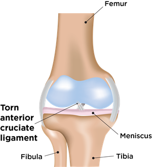 Anterior Cruciate Ligament (ACL) Tears (for Parents)