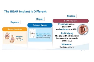 BEAR implant 