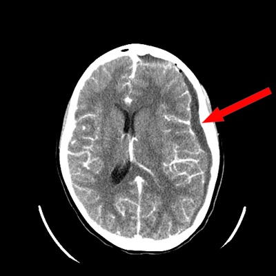 Raynah's CT scan at Children's Wisconsin 