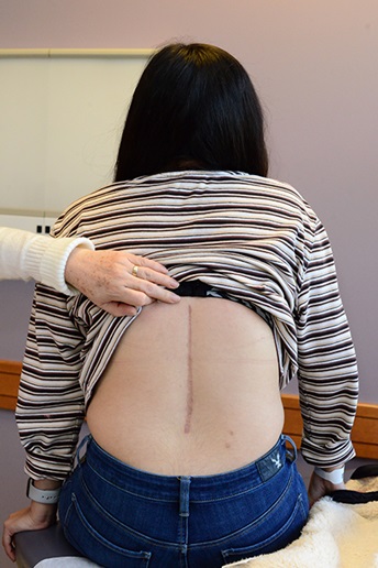 Karina showing her spinal fusion scar at Children's Wisconsin