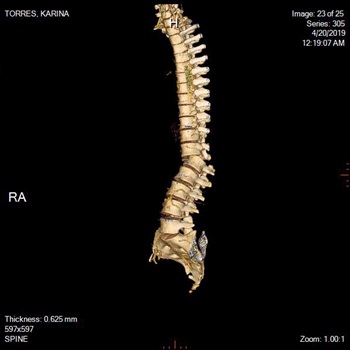 CT scan of Karina's spine at Children's Wisconsin