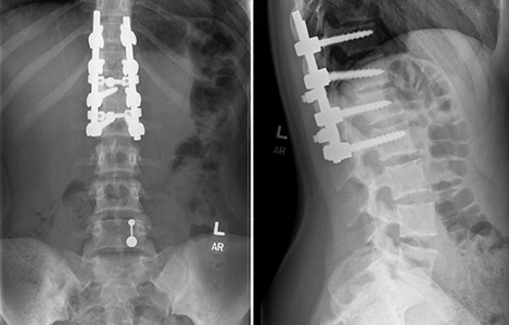 X-rays of Karina's spine at Children's Wisconsin