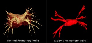 Diagram of normal pulmonary veins compared to pulmonary vein stenosis.