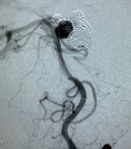 Angiogram showing Recurrent basilar artery aneurysm (yellow arrow) from the back of the brain, with coils pushed away from the aneurysm