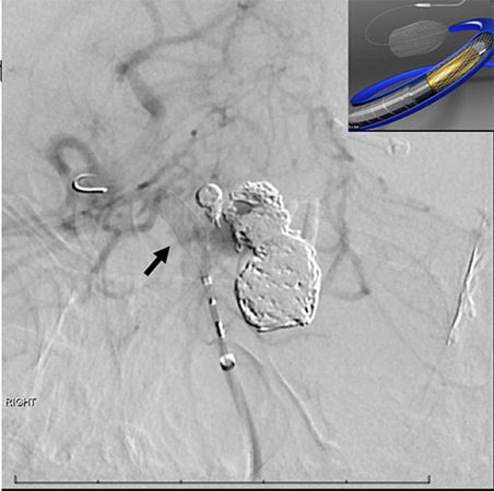  Angiogram showing deployment of pipeline flow diverter stent across the top of the basilar artery  (arrow), with schematic inset (top right corner)