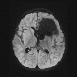 Kaylee awake craniotomy Children's Wisconsin Neurosciences Center cavernous malformation MRI