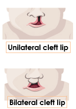 2 Cleft images with text EN