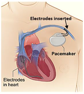 Repositing Pacemaker Pacemaker Placement What Is Conduction System Pacing?
