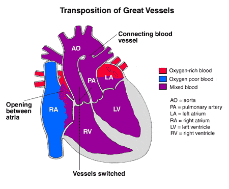 A diagram of a TGA heart with transposition of the great vessels.