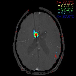 x-ray of the top of a head