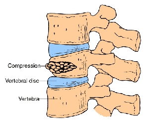 Fracture type - Compression diagram
