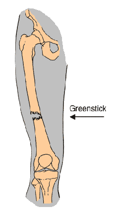 Fracture type - Greenstick diagram